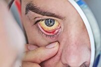 سرطانی که چشم‌ها را تهدید می‌کند