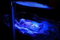 نوردرمانی تنها روش مجاز برای درمان زردی نوزاد است